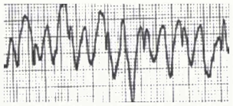 Fibrillation ventriculaire : oscillations anarchiques sans QRS identifiables.