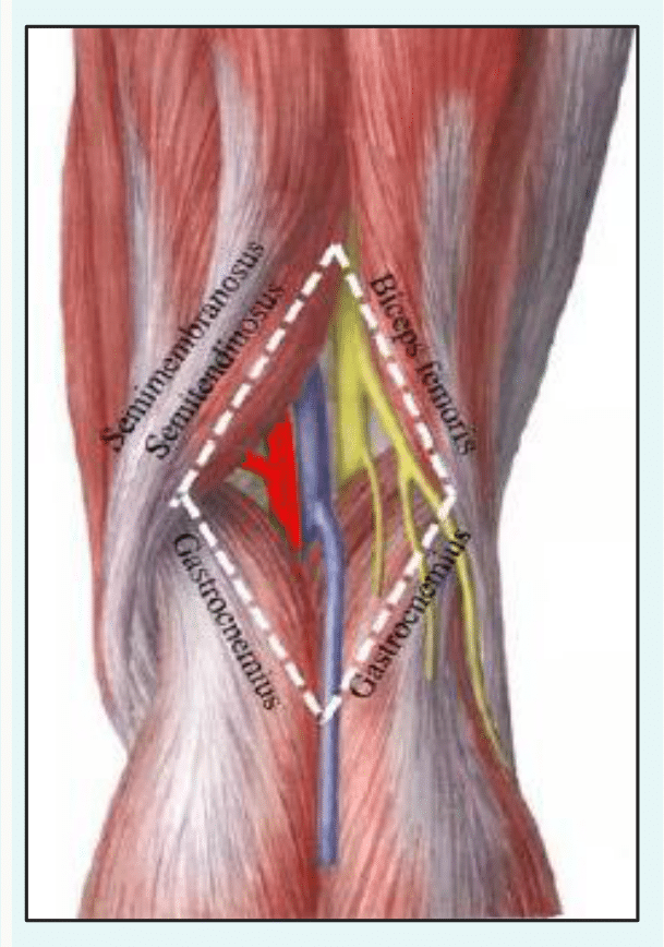 Fosse poplitée en losange à l'arrière du genou et ses limites musculaires, avec le paquet vasculo-nerveux