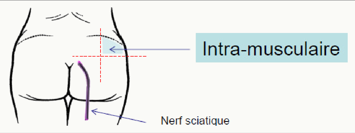 Injection IM fessier avec nerf sciatique