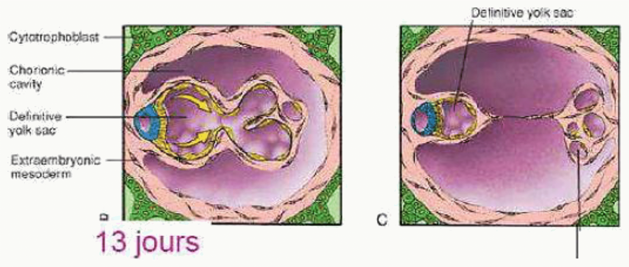 Mésoderme extra-embryonnaire au treizième jour, entre la membrane de Heuser et le cytotrophoblaste