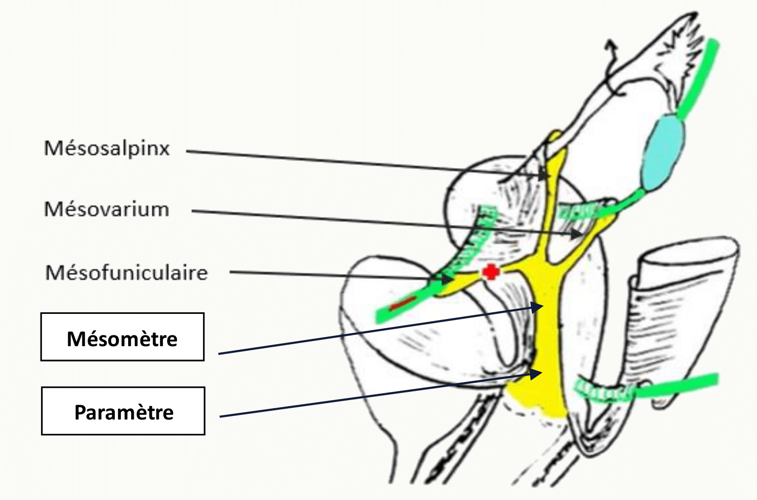 Ligament large et ses parties : mésomètre, mésosalpinx, mésovarium et paramètre