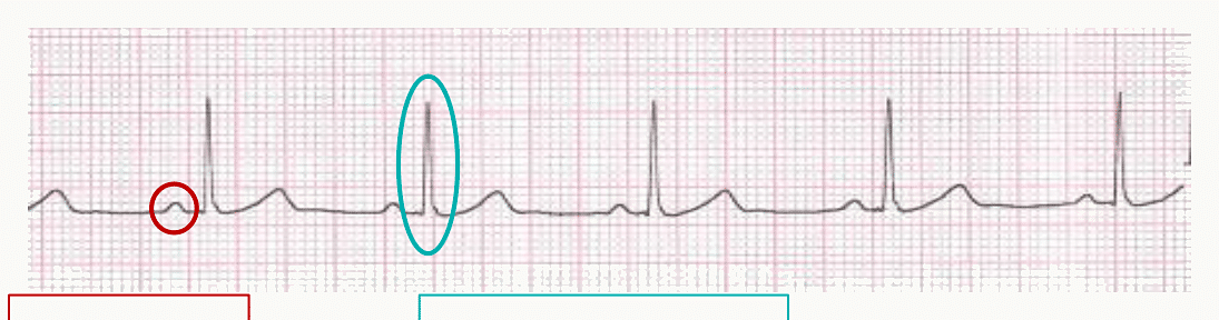 Mesure de la fréquence cardiaque sur un tracé ECG à partir de l'espace RR.