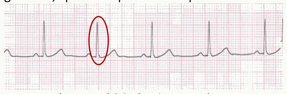 Onde P entourée sur un tracé ECG normal.