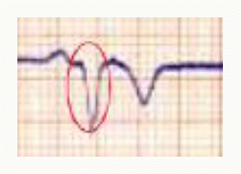 Onde Q large et profonde signant une nécrose myocardique après un infarctus.