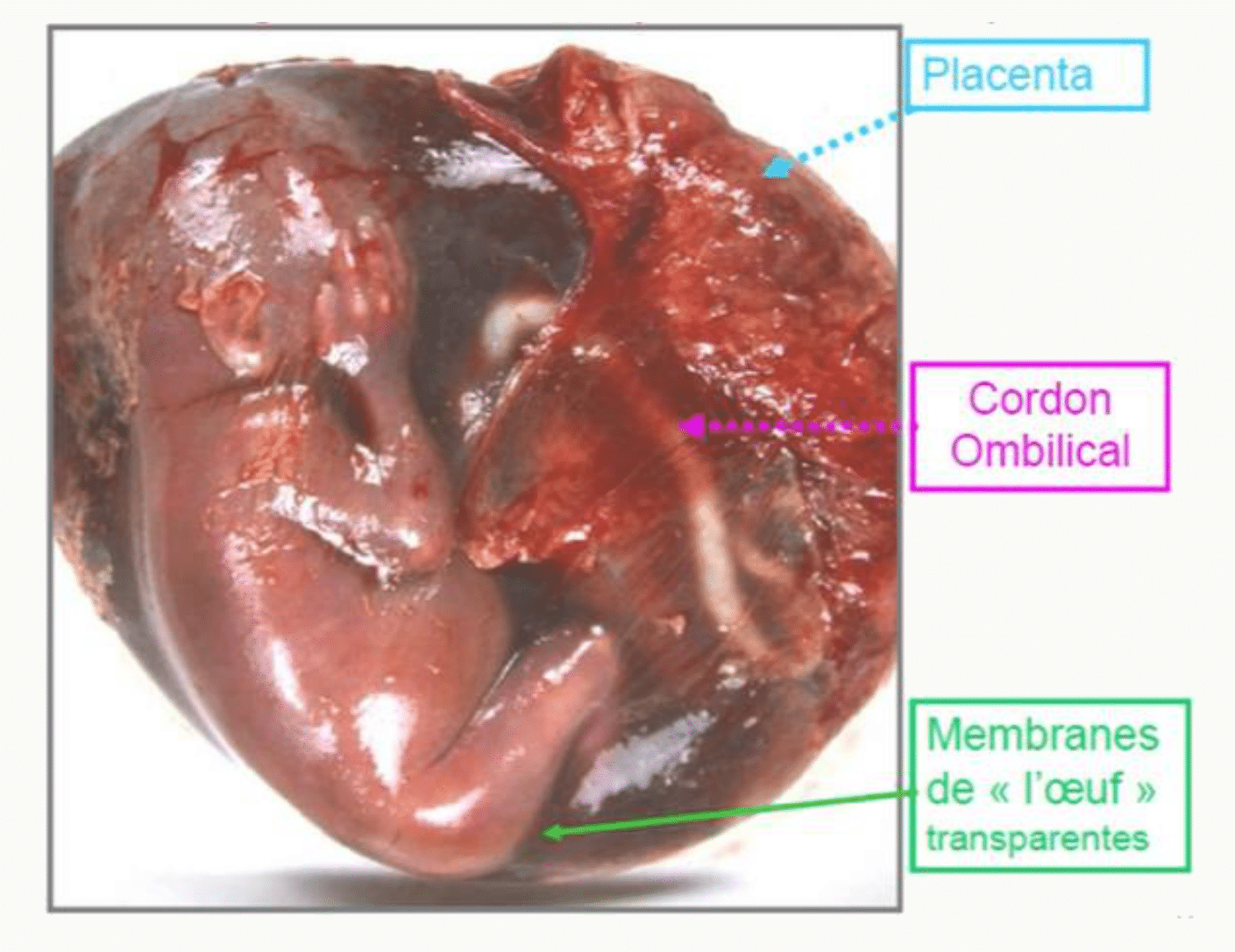 Placenta à terme, cordon ombilical et membranes de l'œuf transparentes entourant le fœtus