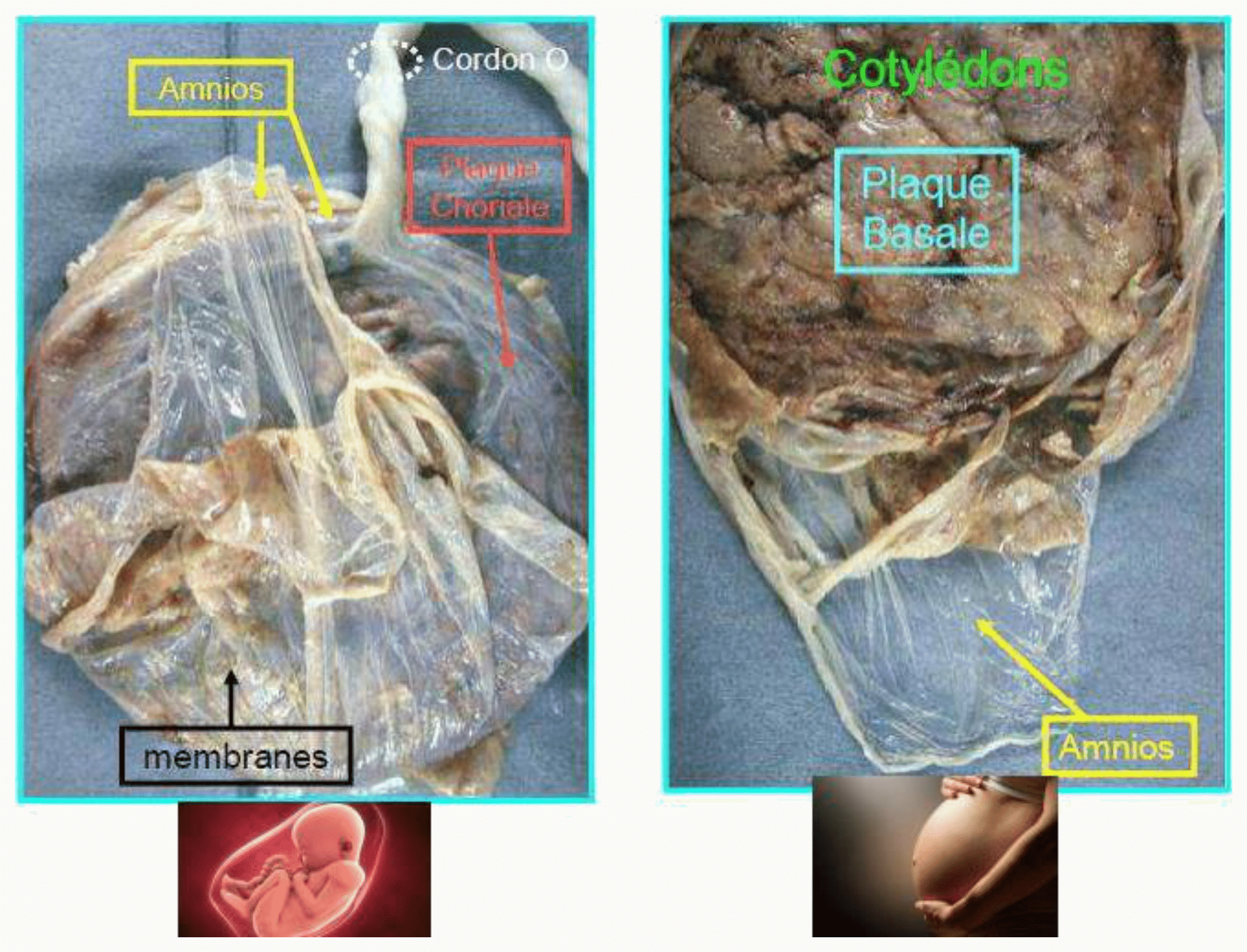 Photographies du placenta et de ses membranes