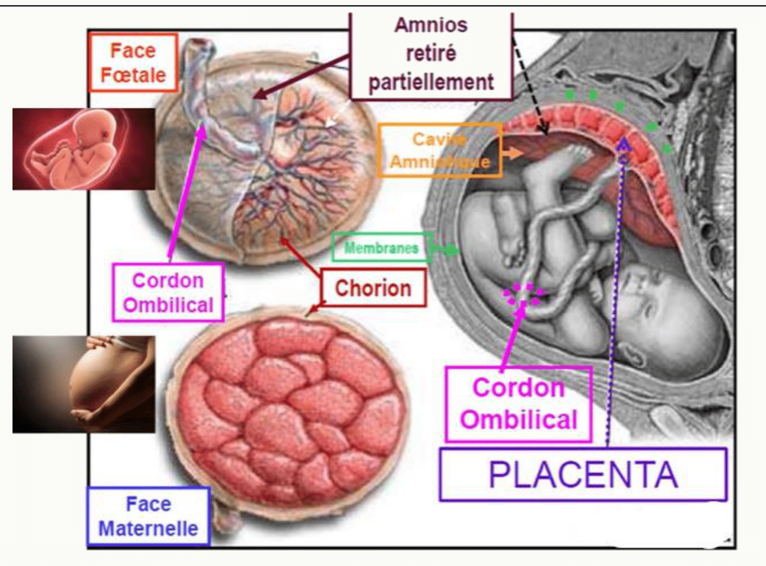 Placenta vu par sa face fœtale (plaque choriale, cordon ombilical) et par sa face maternelle (plaque basale, cotylédons)