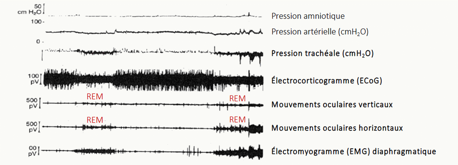 Polysomnographie chez un nouveau-né montrant l'EEG, les mouvements thoraciques, abdominaux et le flux d'air, avec identification des stades de sommeil et de la respiration périodique.