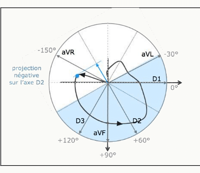 Projection négative de la boucle QRS sur l'axe D2 du cercle de Bailey.