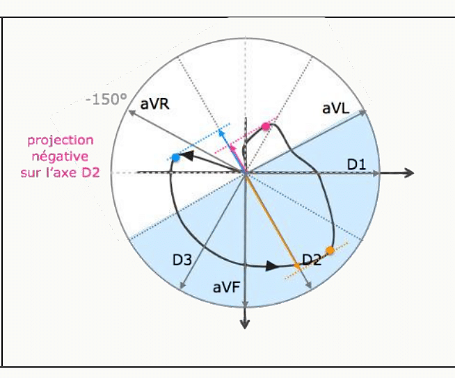 Projection positive de la boucle QRS sur l'axe D2.