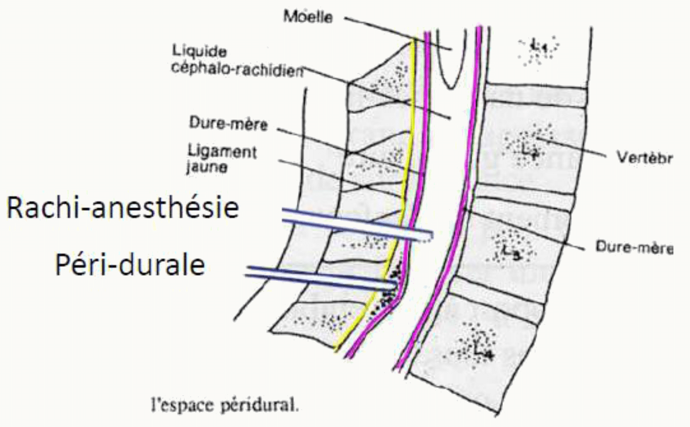 Coupe colonne vertébrale rachi-anesthésie et péridurale