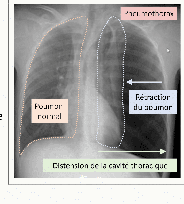 Radiographie thoracique montrant un pneumothorax avec rétraction du poumon droit et déviation de la trachée, illustrant la pression pleurale négative et son rôle dans le maintien du poumon expansé.