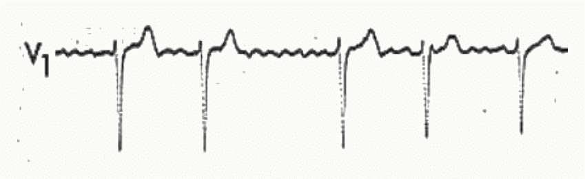 Tachycardie ventriculaire : succession rapide de QRS larges monomorphes.