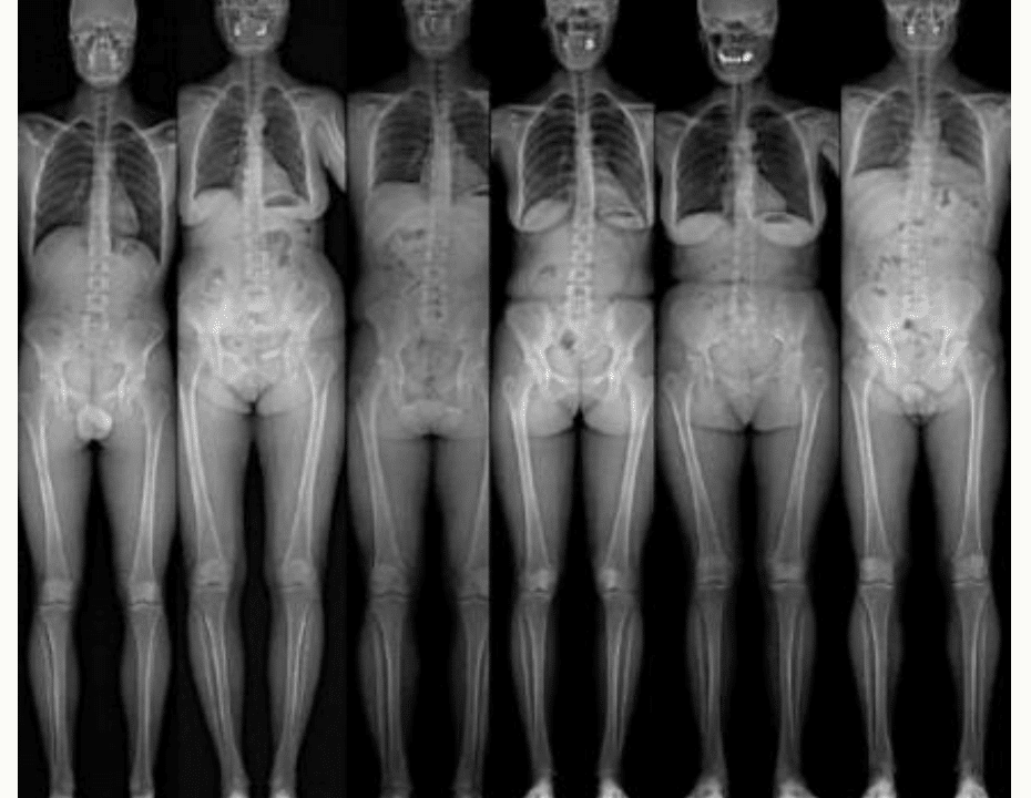Radiographies comparées des membres inférieurs de cinq sujets : variabilité de la largeur du bassin et des axes osseux