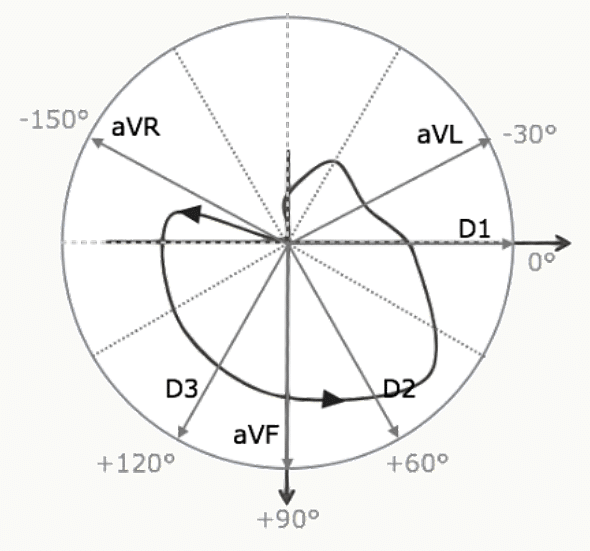 Boucle QRS du vectocardiogramme avec ses projections sur les six dérivations frontales.